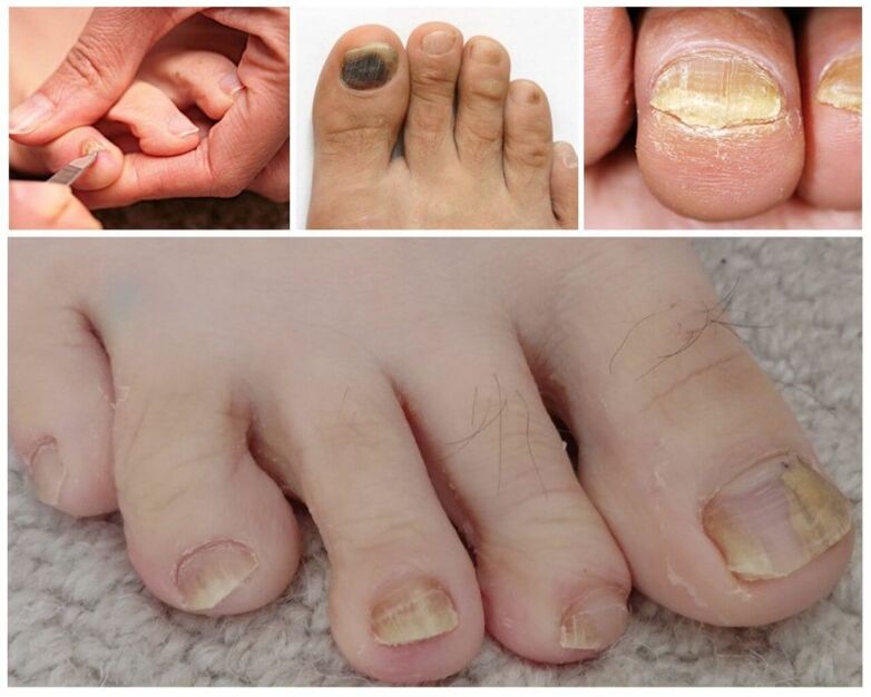 Az onychomycosis tünetei