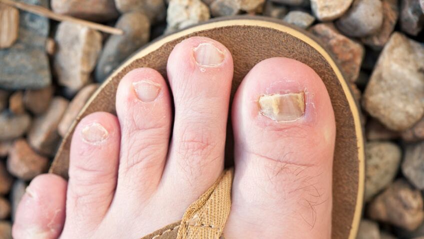 A körmök onikchomycosis